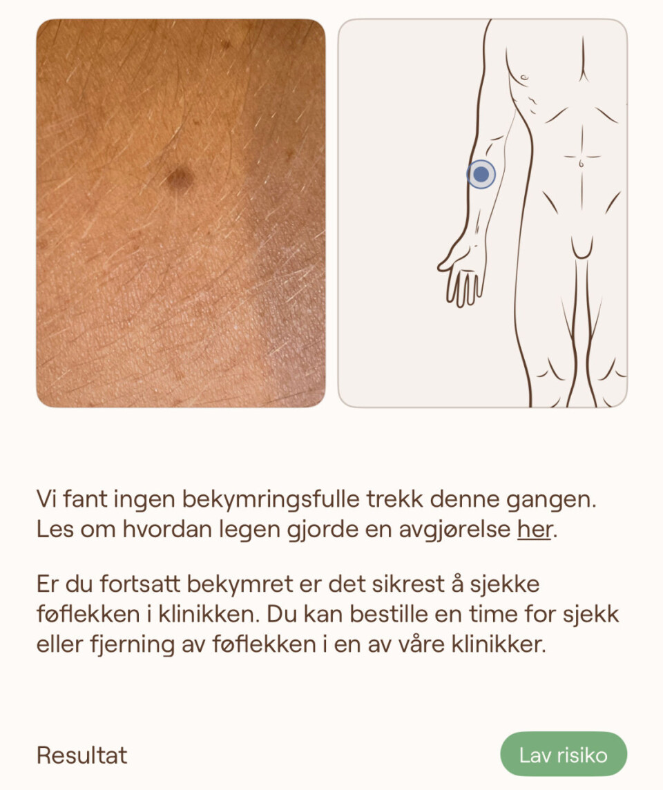 Helse-skann: I Oteria-appen kan man skanne føflekker med jevne mellomrom og dermed følge med på endringer. Videre får man anbefaling om oppfølging etter behov.